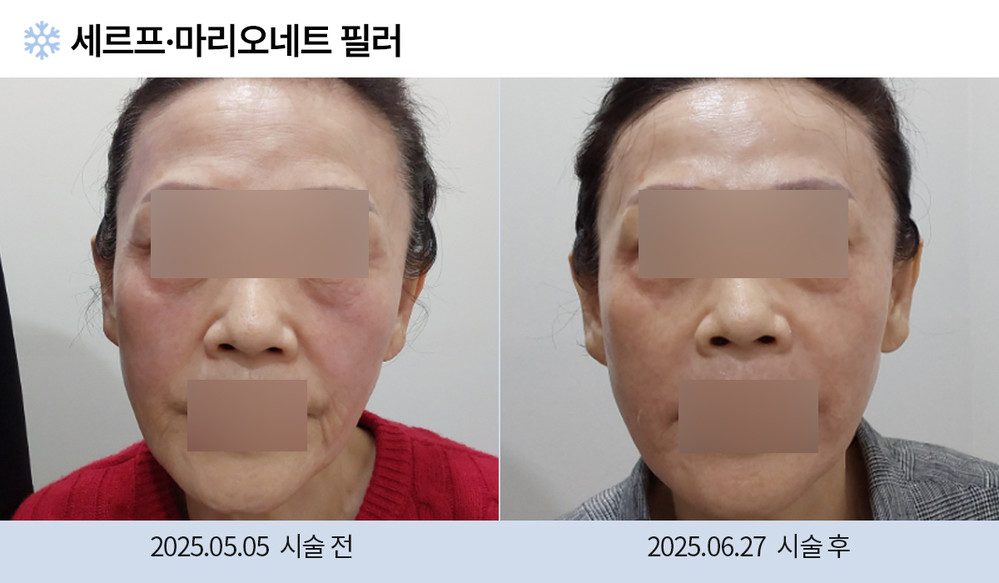 세르프 마리오네트 필러